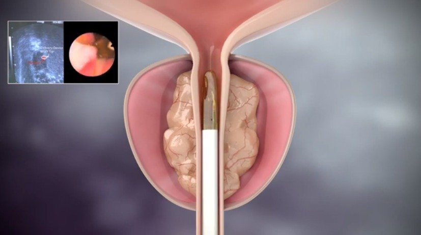 Tratamento inovador para próstata chega ao Brasil